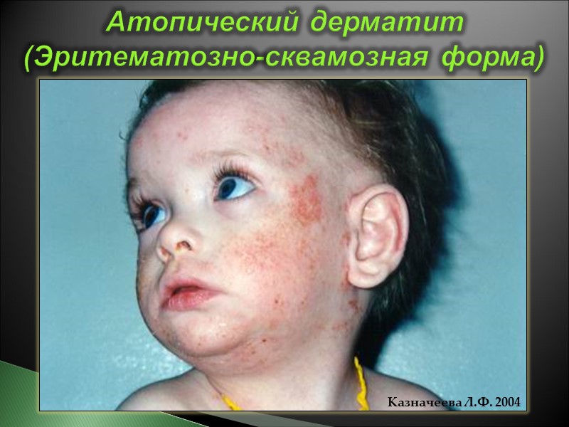 Казначеева Л.Ф. 2004 Атопический дерматит (Эритематозно-сквамозная форма)